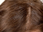 Dandruff Remedies Aid