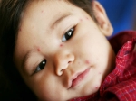 Prevention And Natural Remedies For Chicken Pox