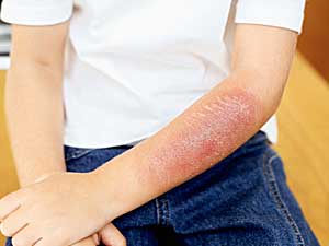 Heal Burn Scars