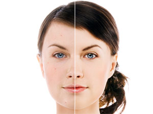 Alcohol Facials