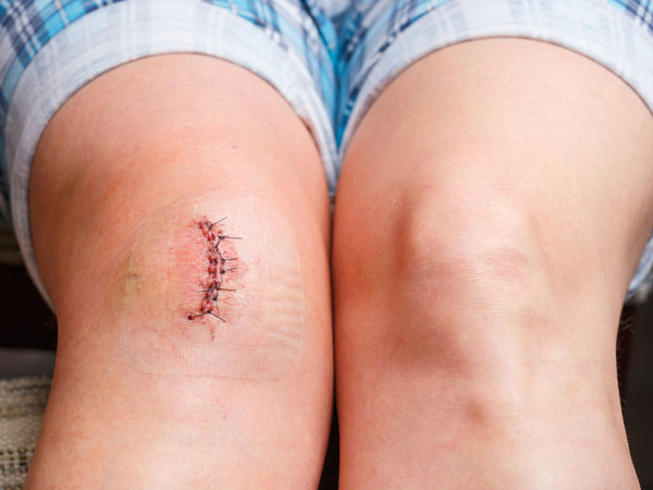 15 दिन में गायब करें चेहरे के चोट के निशान इन चमत्कारी उपायों से