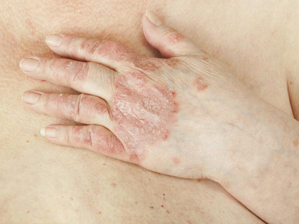 स र यस स स न ह पर श न क य क अब ह इसक घर ल उपच र Home Remedy For Psoriasis Hindi Boldsky