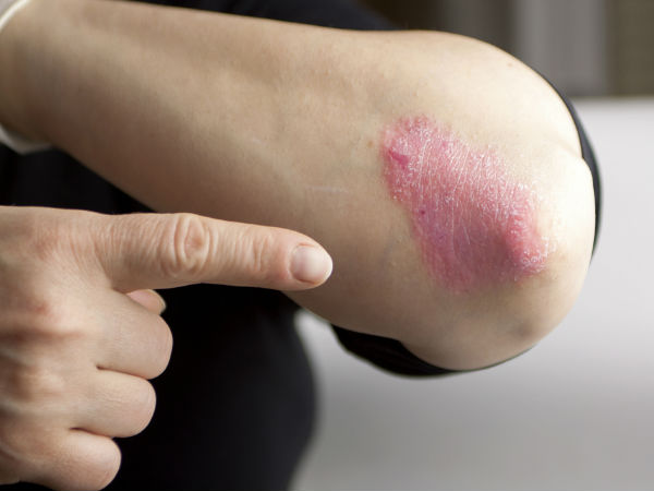 स र यस स स न ह पर श न क य क अब ह इसक घर ल उपच र Home Remedy For Psoriasis Hindi Boldsky