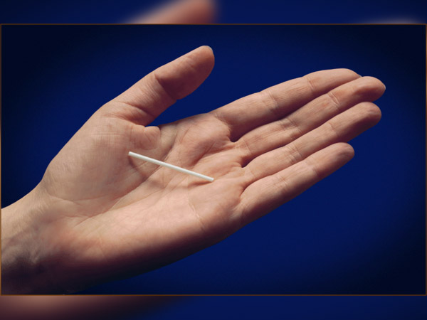 Birth Control Implant Birth Control Implant