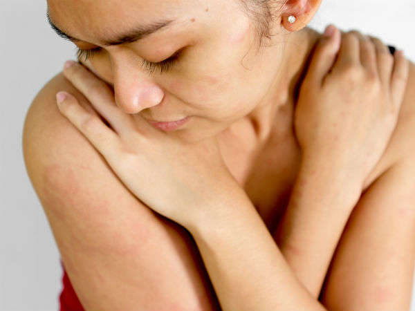 2. चेहरे का लाल पड़ना : 2. चेहरे का लाल पड़ना :