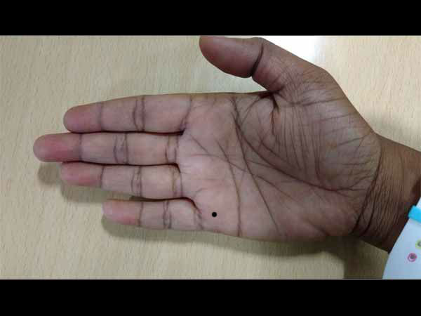 हथेली पर बनी शादी की रेखा पर तिल