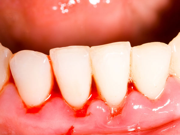 मसूड़ों से खून निकलने के कारण