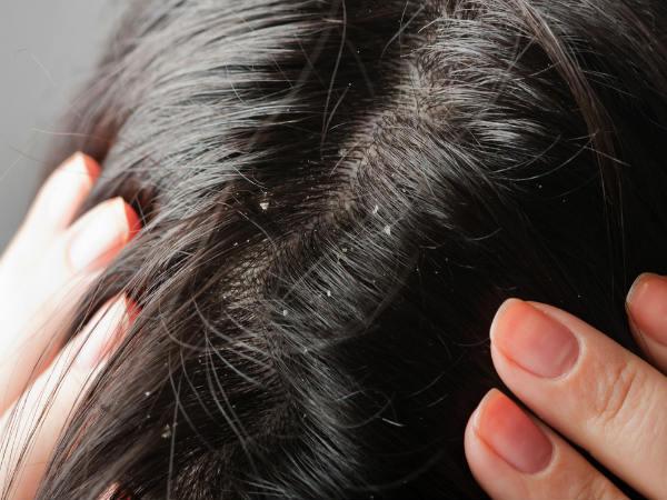 स्कैल्प के इंफेक्शन को करें दूर