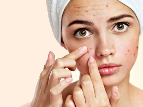 मानसून में एक्ने से बचने के टिप्स