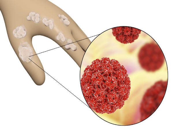 एचपीवी (HPV) के लक्षण