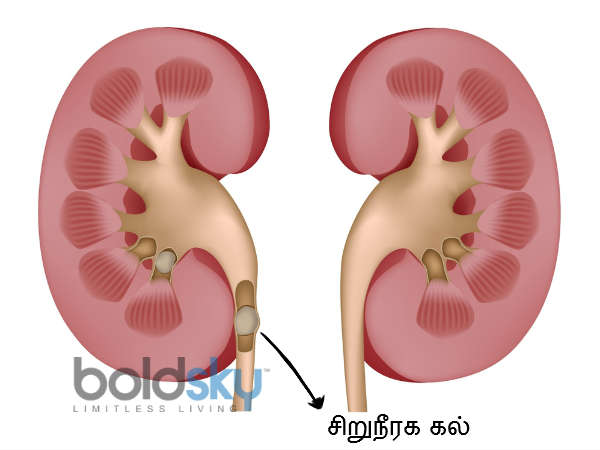 पथरी के दर्द से राहत
