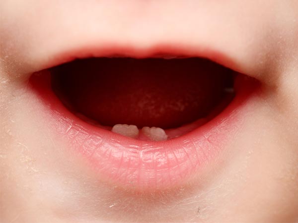 नर्सिंग बॉटल कैविटी की समस्या से बचें