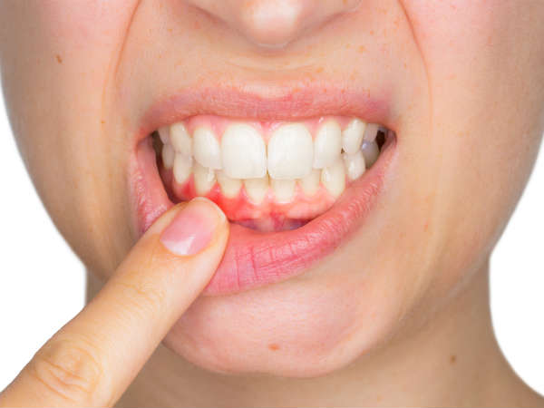 मसूड़े रहते है स्वस्थ मसूड़े रहते है स्वस्थ