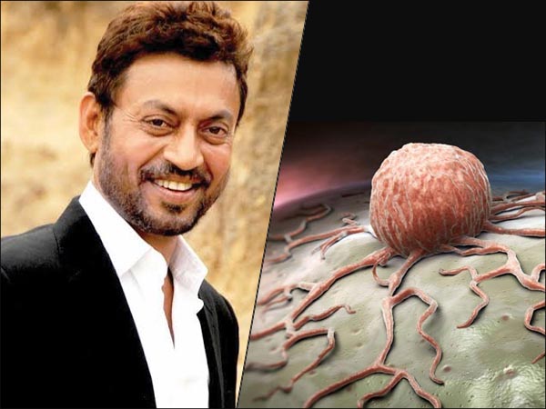 Irrfan Khan Death : क्या होता है कोलन ...
