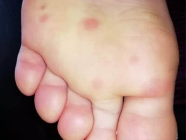 कोरोनावायरस: पैरों पर बैंगनी रंग के ...