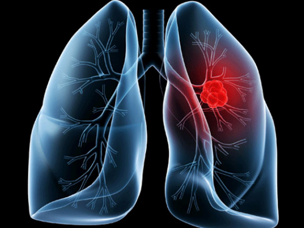 लंग कैंसर (Lung Cancer) क्या है?