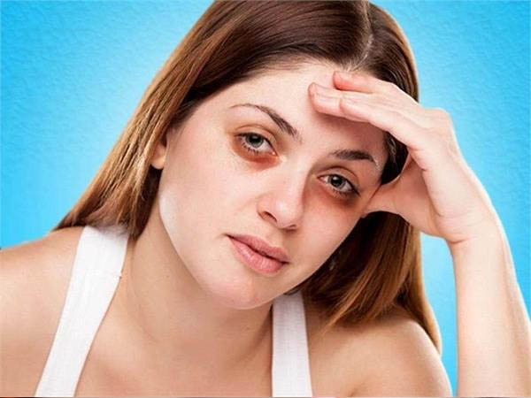 डार्क सर्कल डार्क सर्कल