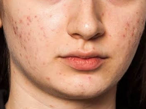 लौंग के तेल का करें इस्तेमाल लौंग के तेल का करें इस्तेमाल