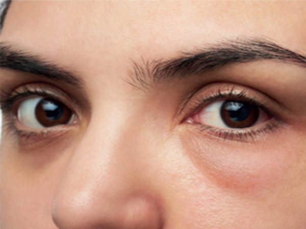 आंखों में सूजन के कारण आंखों में सूजन के कारण