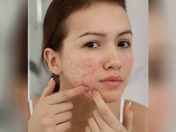 रेटिनाइड्स क्रीम रेटिनाइड्स क्रीम