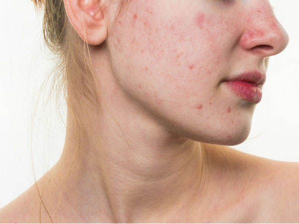 मेन्स्ट्रुअल एक्ने से कैसे पाएं निजात मेन्स्ट्रुअल एक्ने से कैसे पाएं निजात