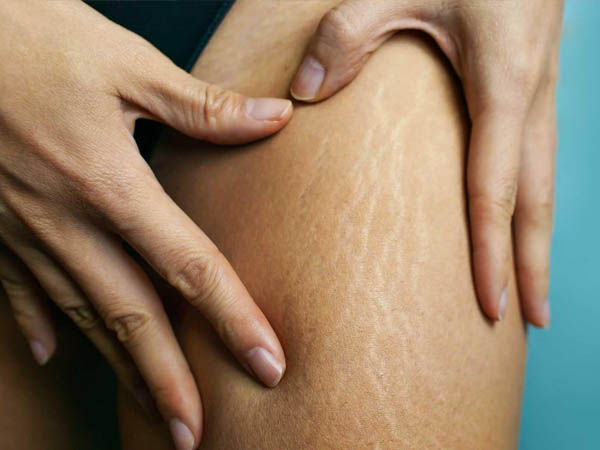 स्ट्रेच मार्क्स के लिए सबसे बेहतर मसाज ऑयल स्ट्रेच मार्क्स के लिए सबसे बेहतर मसाज ऑयल