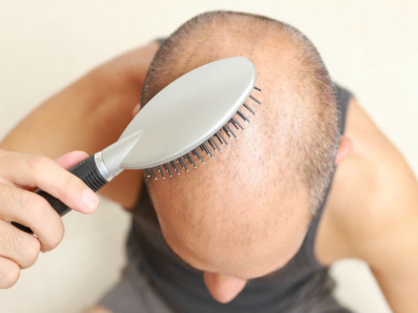 क्या है एलोपिशिया एरिएटा क्या है एलोपिशिया एरिएटा