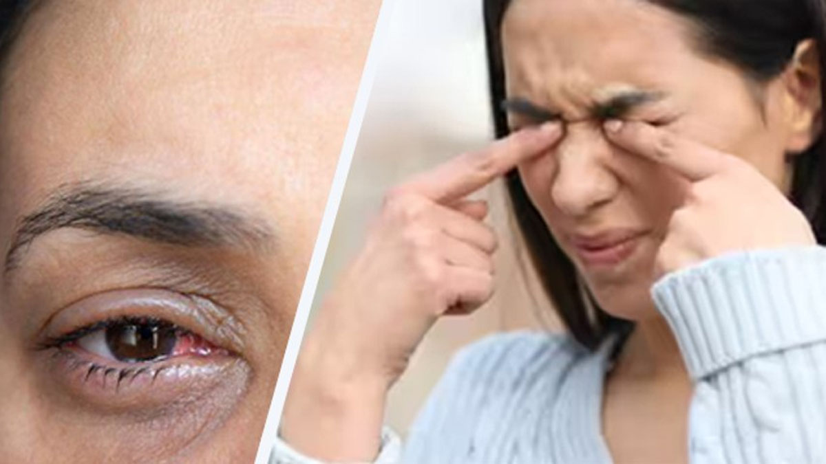 Eye Flu आपको भी हो गया आईफ्लू! जानें आंख आने पर क्या करें और क्या नहीं? Eye Flu Hone Par Kya
