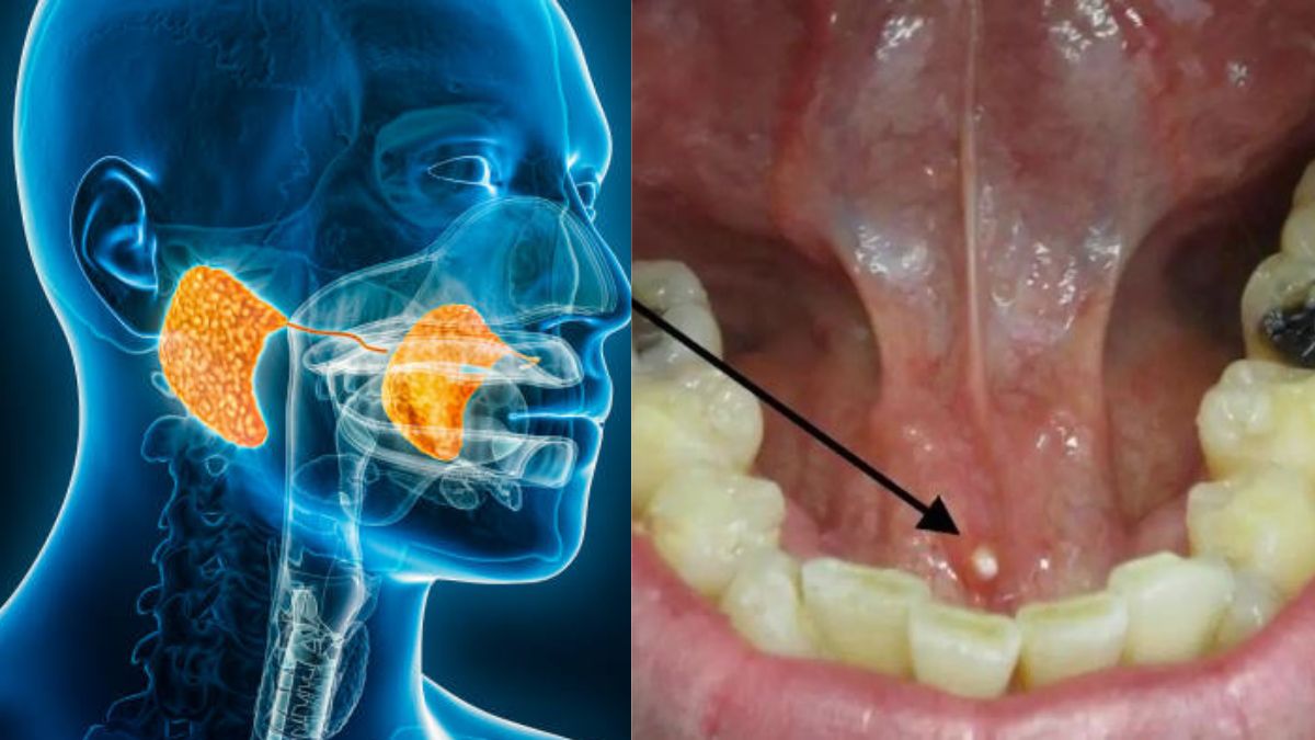 Mouth Stone क‍िडनी ही नहीं मुंह की पथरी भी साबित हो सकती है जानलेवा, ये हैं बचाव और लक्षण